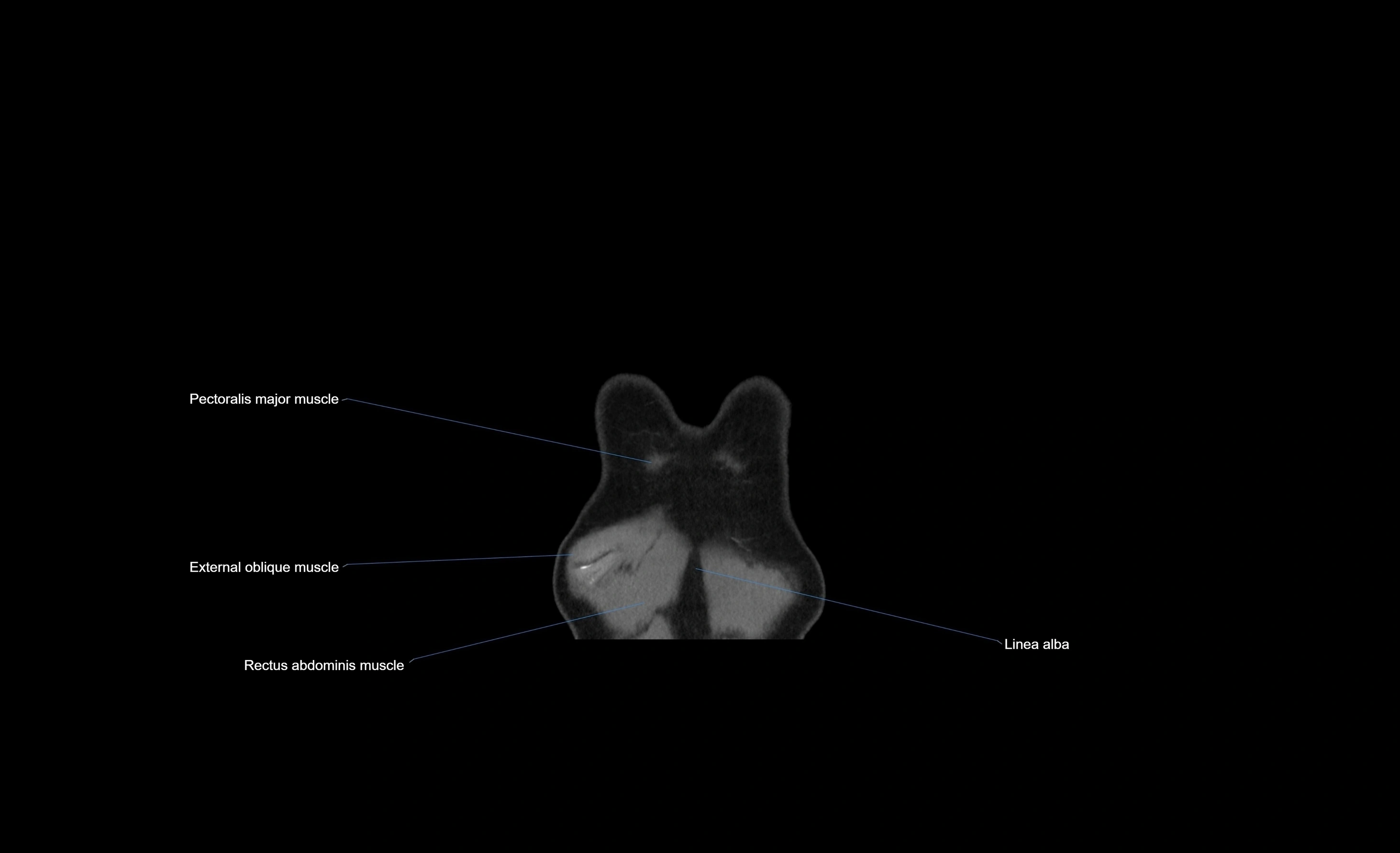 CT chest (thorax) labelled coronal cross sectional anatomy radiology image-00109.webp